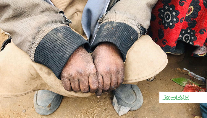 دستان این فرزند یارمحمد سیاه و ترکیده است و این بهعلت جمعآوری زبالهها برای سوخت در زمستان است. با وجود آن هم اغلب شبهای شان را با سردی صبح میکنند.